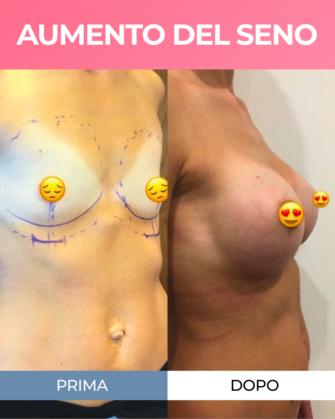 AUMENTO DEL SENO