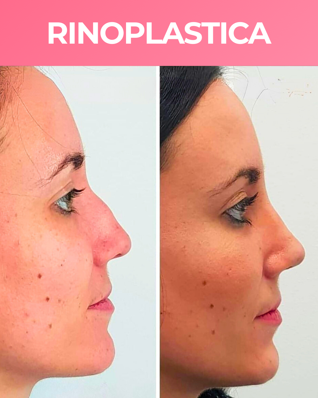 RINOPLASTICA