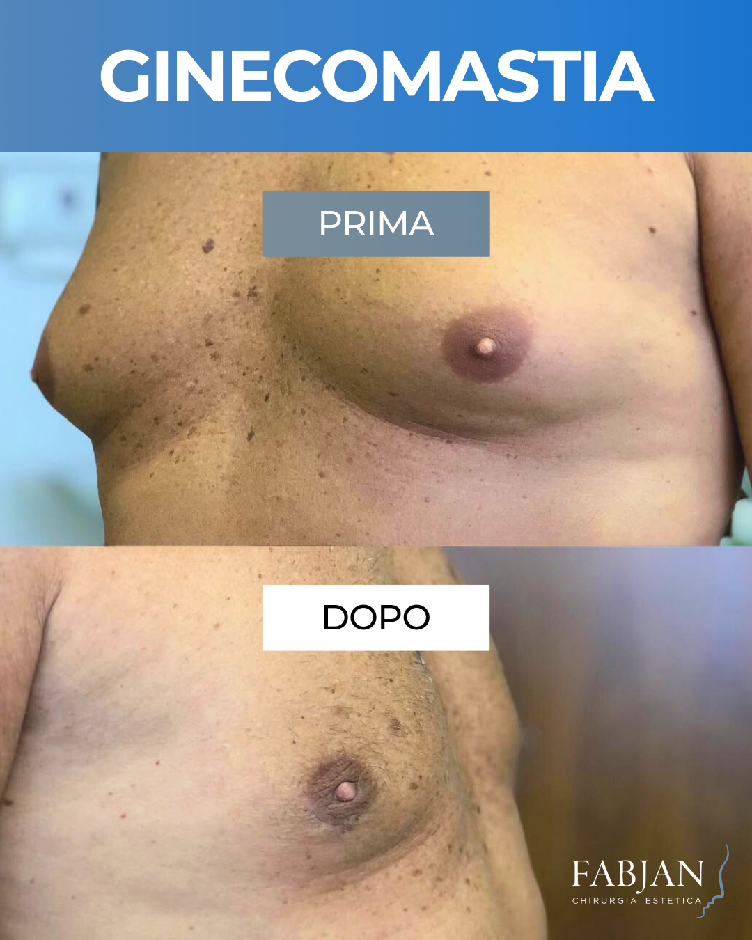 GINECOMASTIA