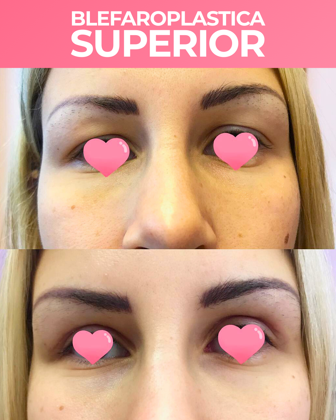 BLEFAROPLASTICA