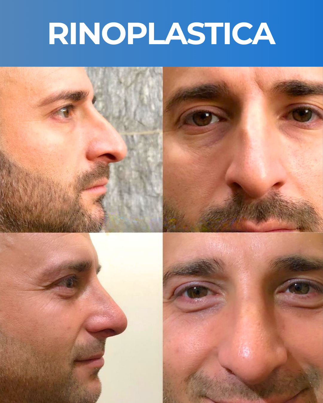 RINOPLASTICA