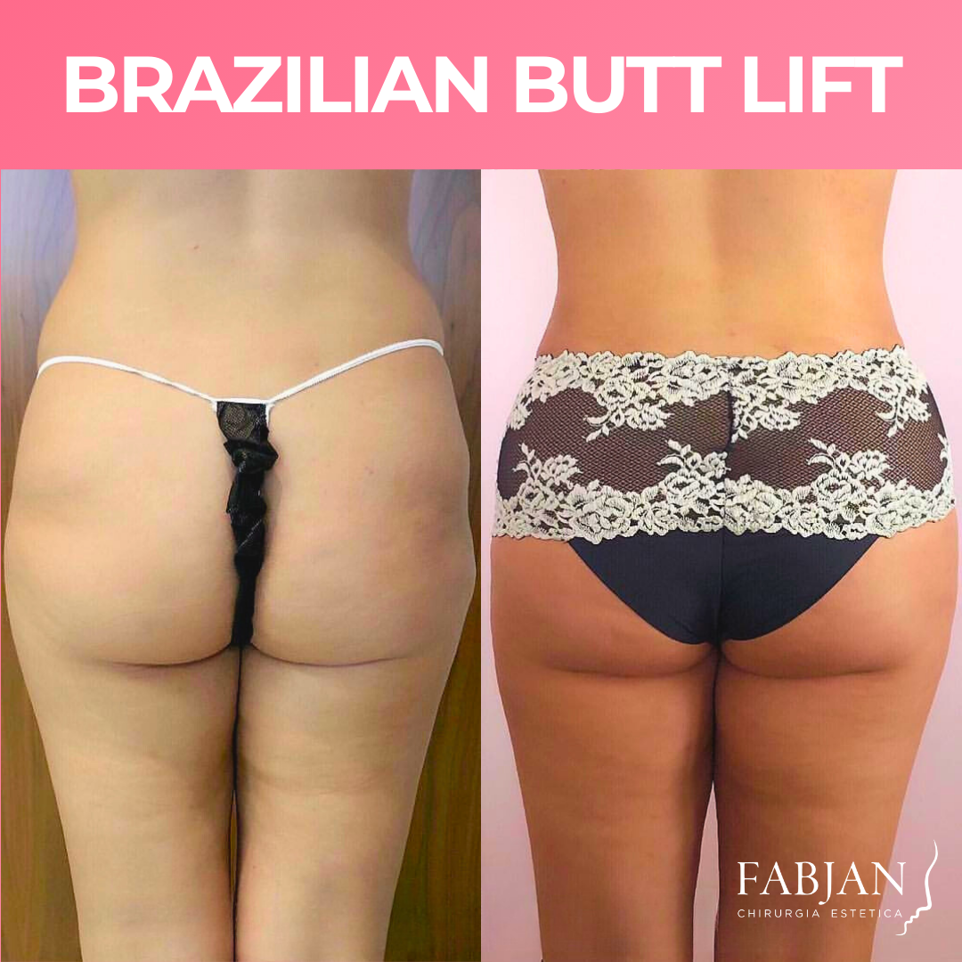 Brazilian butt lift - Chirurgia Fabjan