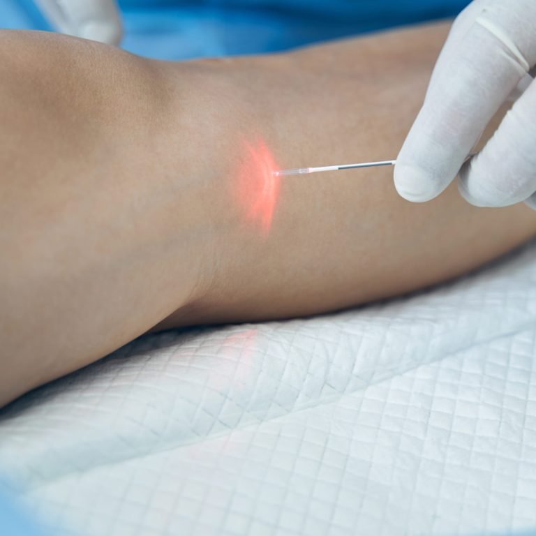 Close up photo of a laser fiber in hand of a doctor in latex glove